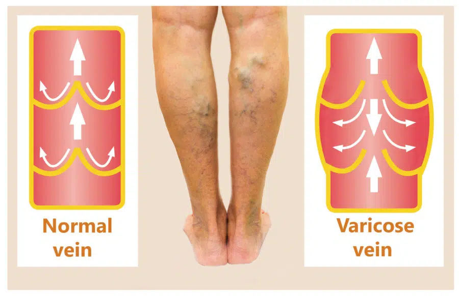 Varicose Veins Treatment Options in Tomball: Heart & Vascular